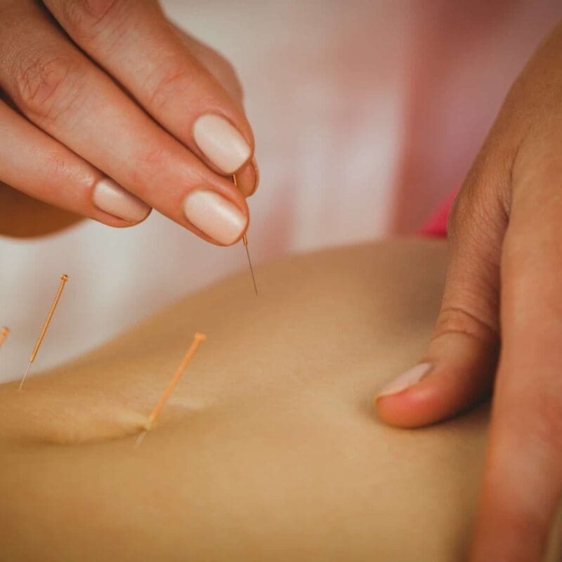 Acupuncture for Weight Loss