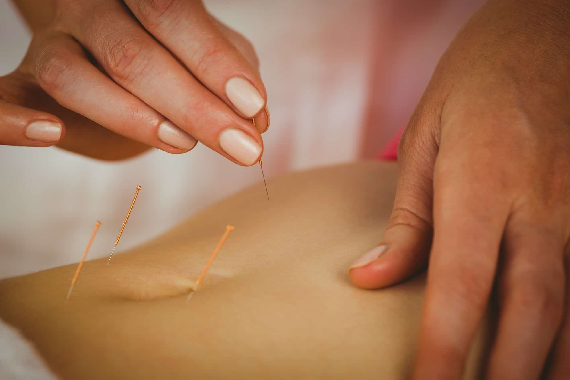 Acupuncture for Weight Management